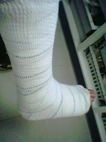 Ma jambe dans la pltre 