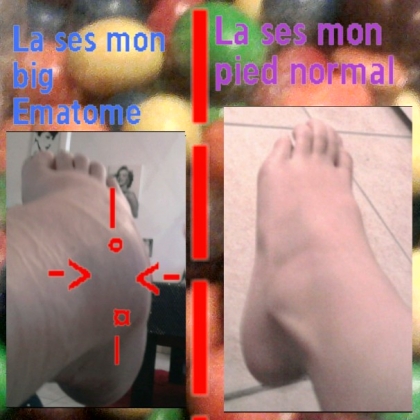 VOICI MON BIG EMATOME