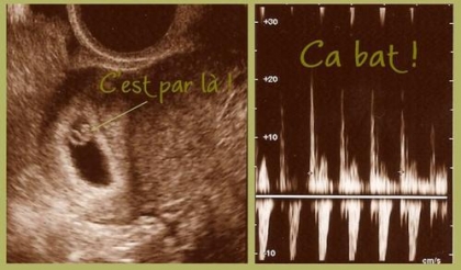 l ecographie de ma fille